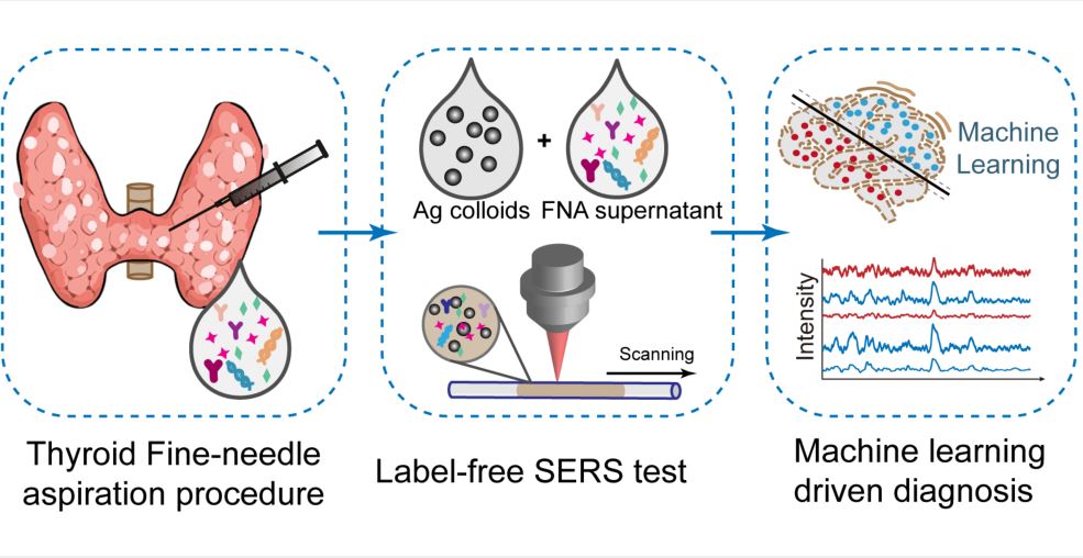 Label-Free Surface-Enhanced Raman Spectroscopy with Machine Learning for the Diagnosis of Thyroid Cancer by Using Fine-Needle Aspiration Liquid Samples