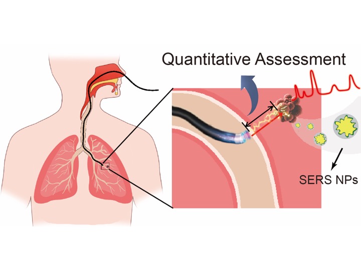 Raman-Guided Bronchoscopy: Feasibility and Detection Depth Studies Using Ex Vivo Lung Tissues and SERS Nanoparticle Tags